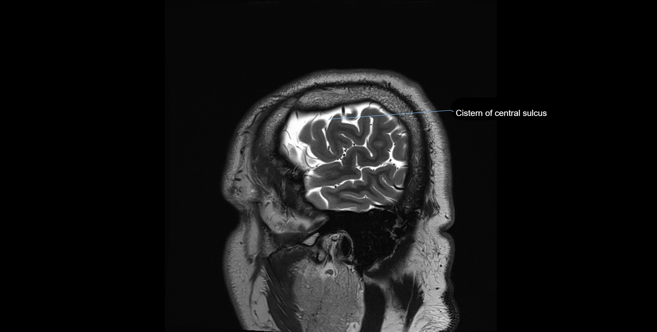 Brain cisterns  and ventricles sagittal anatomy 3T MRI image-img-00001-00002.webp